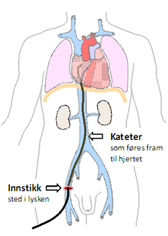 Radiofrekvens_kateterablasjon_innstikk.jpg